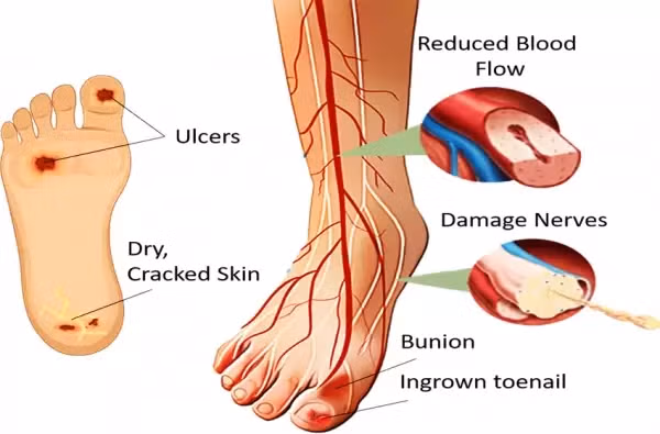 Kondisi kaki akibat terserang diabetes